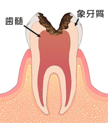 歯髄虫歯