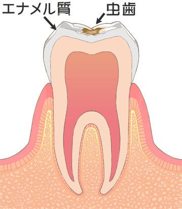 エナメル質虫歯
