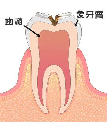 象牙質虫歯